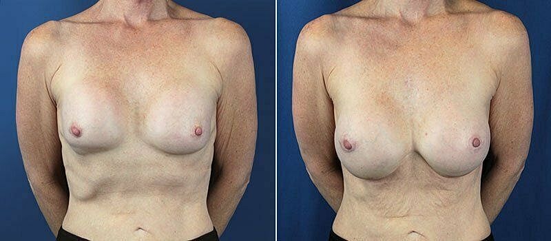 Breast reconstruction before and after images.