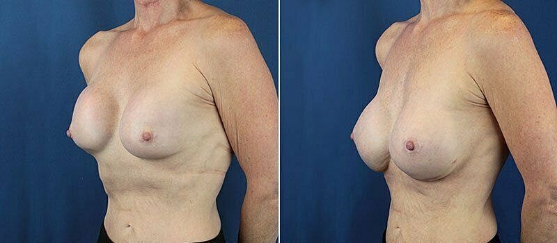 Post-operative breast enhancement before and after.