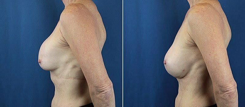 Before and after breast enhancement comparison image.