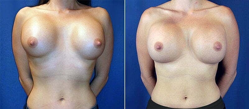 Breast augmentation before and after comparison.