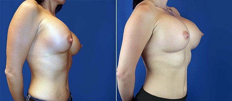 Before and after body contouring comparison.