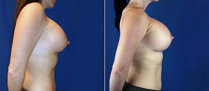 Breast augmentation before and after comparison.