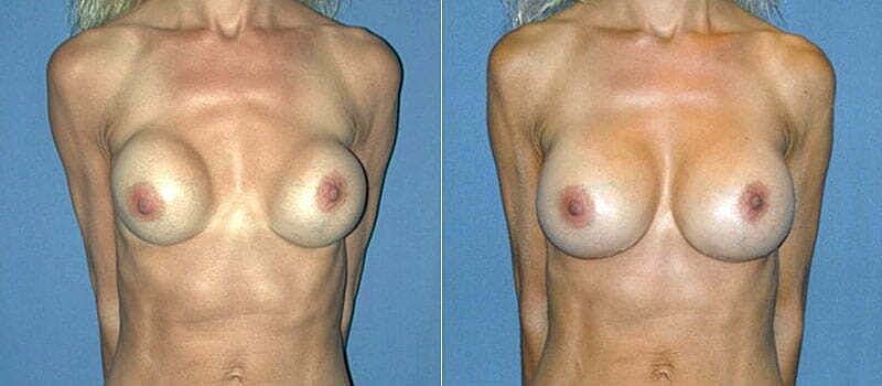 Before and after breast augmentation comparison.