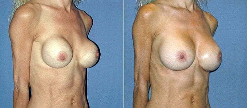 Before and after breast augmentation comparison.