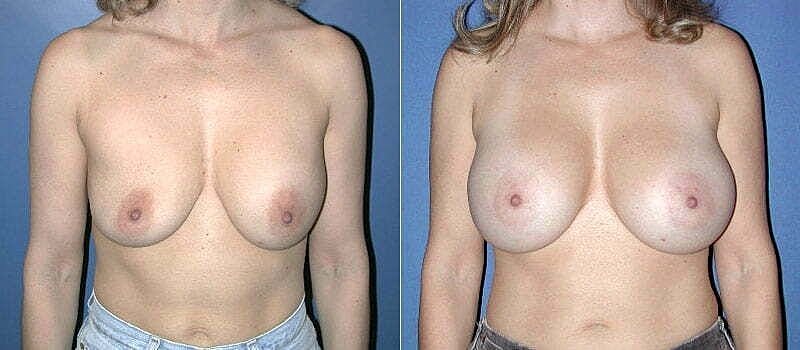 Before and after breast enhancement photos