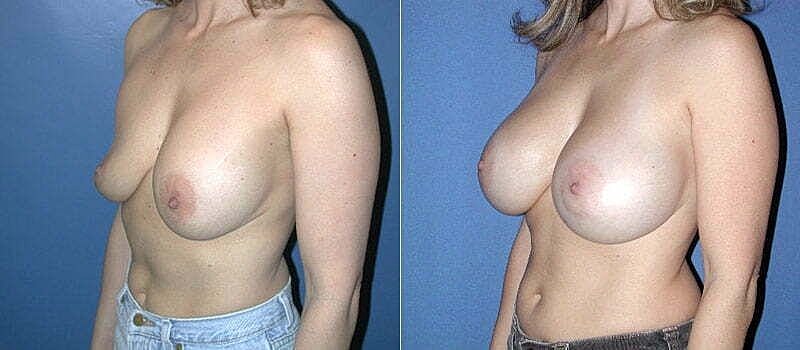 Breast augmentation before and after comparison.