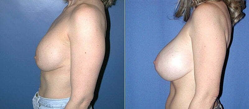 Before-and-after breast augmentation comparison image
