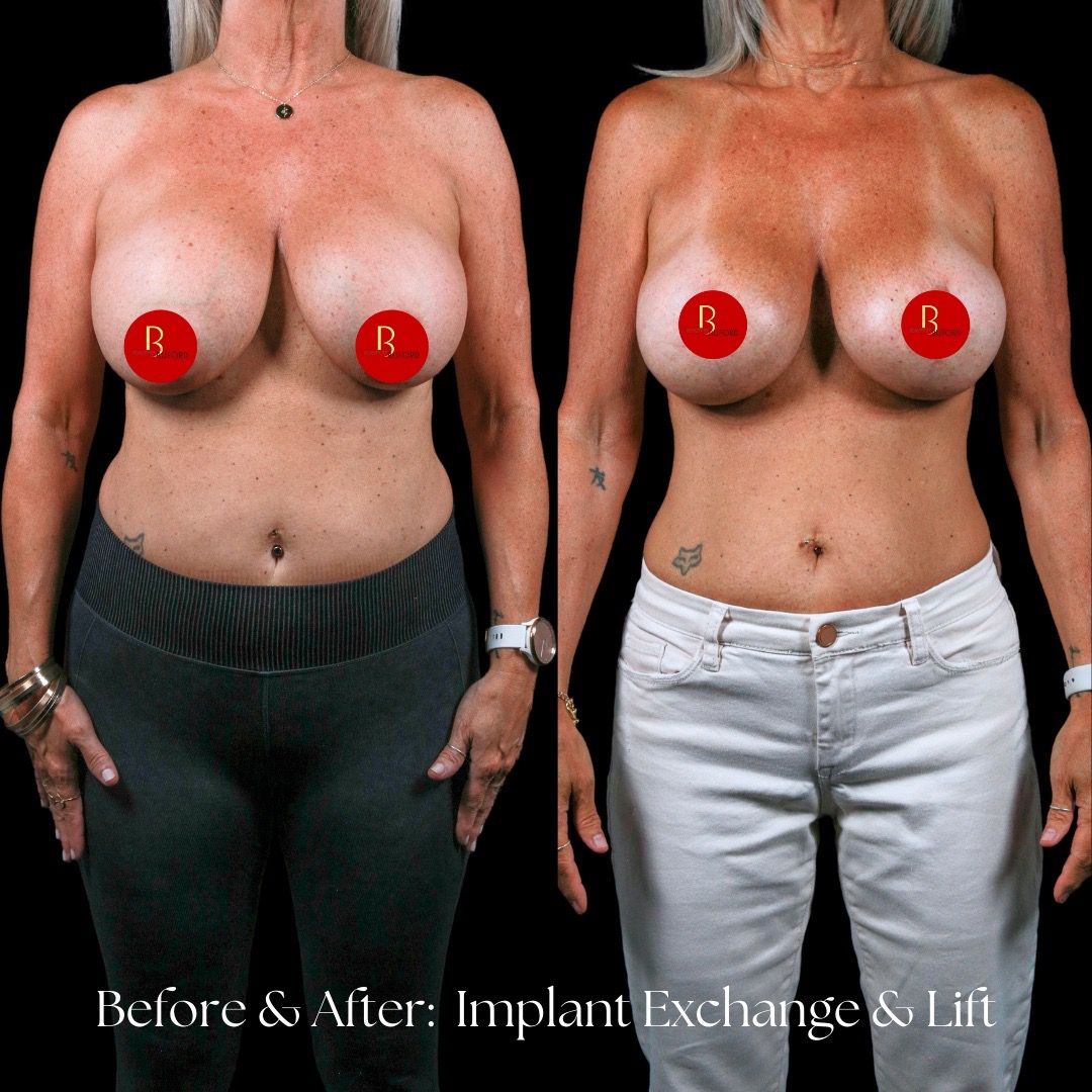 Breast Lift Before & After