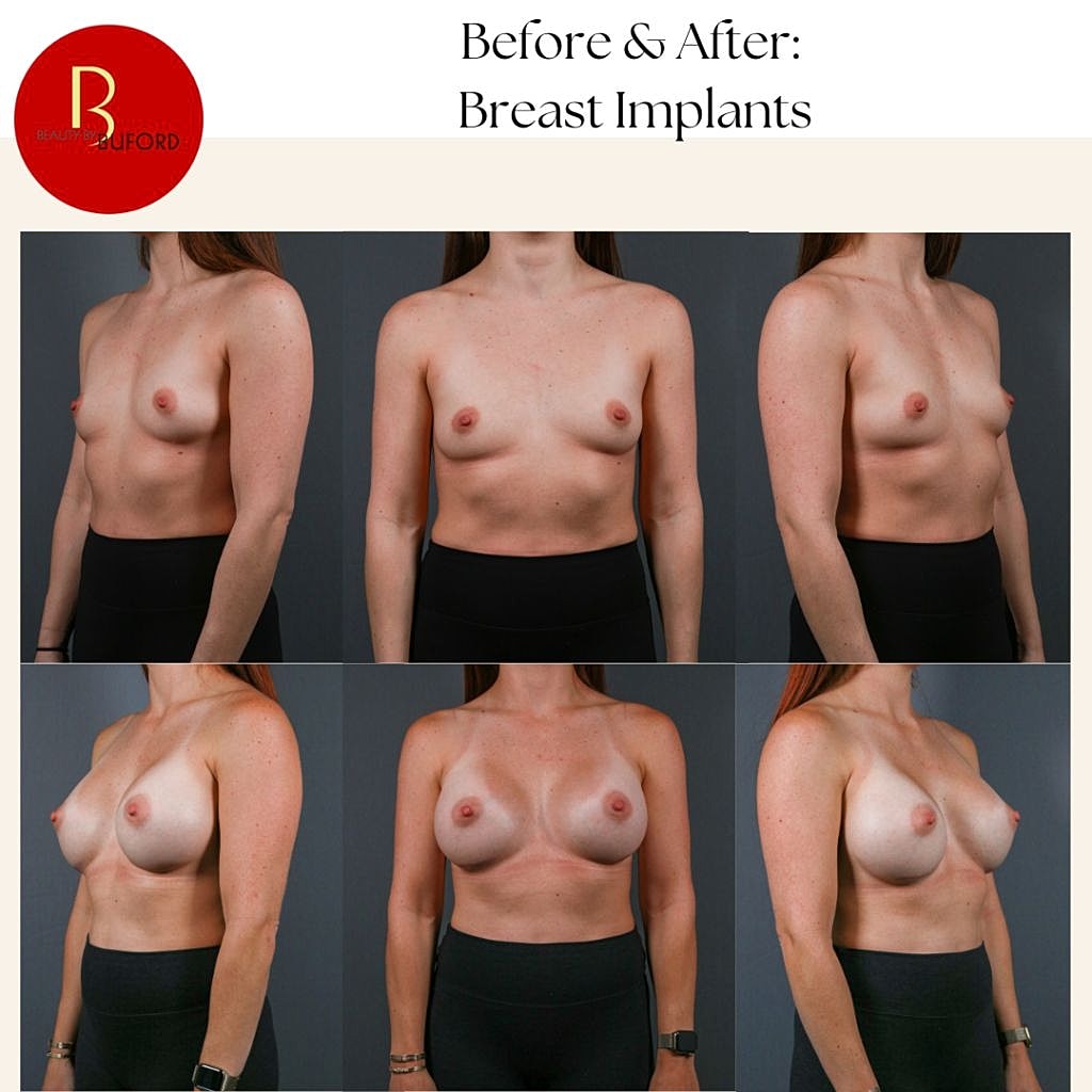 Before and after breast implant results comparison.