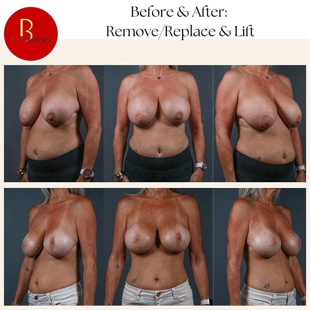 Breast surgery before and after transformation photos