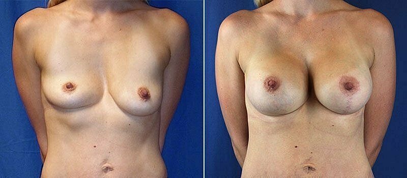 Before and after breast enhancement comparison.