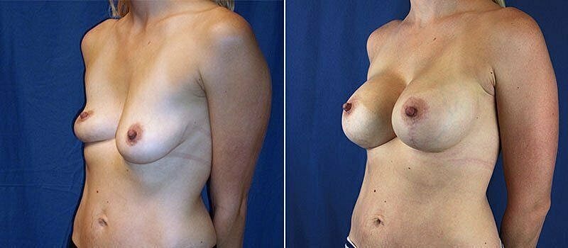 Before and after breast augmentation comparison photos.