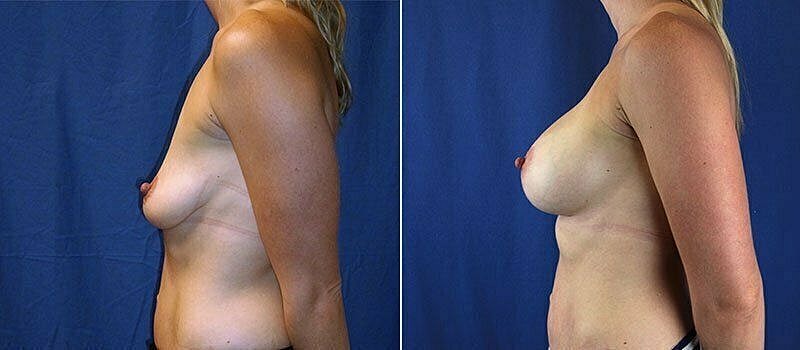 Post-surgery breast augmentation before and after images.