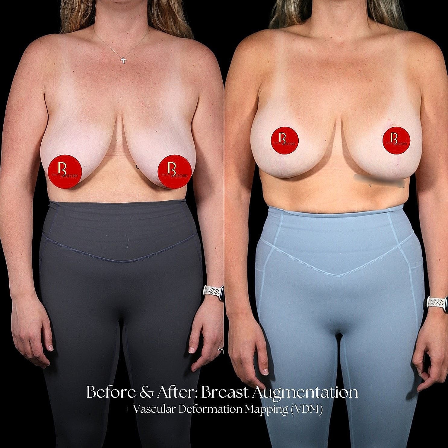 Before and after breast augmentation comparison image.