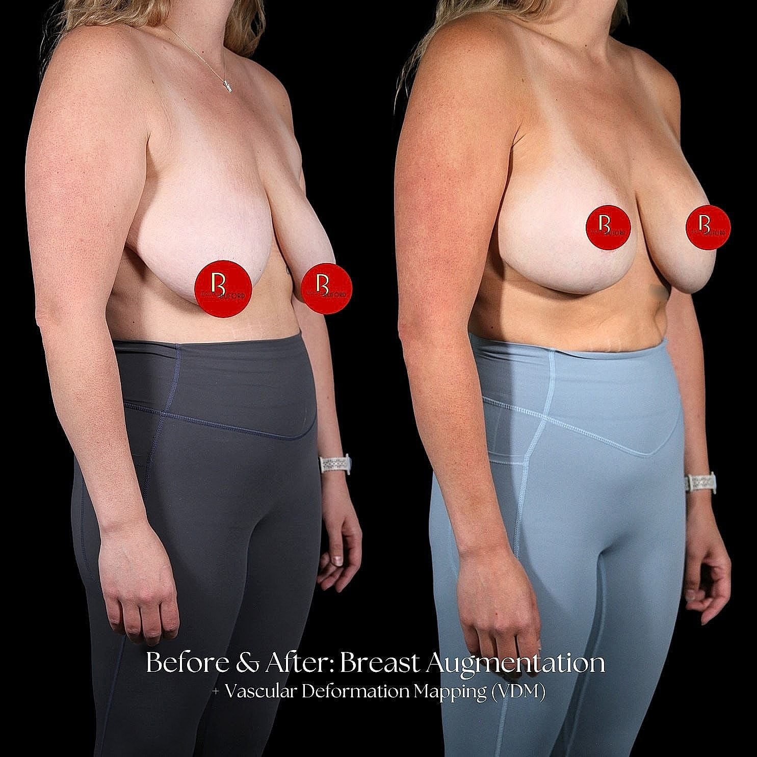 Before and after breast augmentation comparison image.