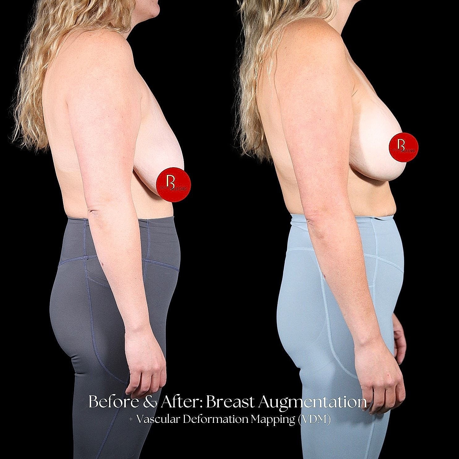 Before and after breast augmentation comparison image.