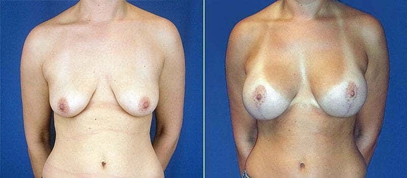 Before and after cosmetic breast procedure photos.
