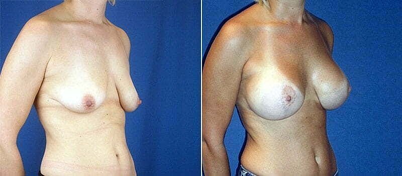 Before and after breast enhancement comparison image.