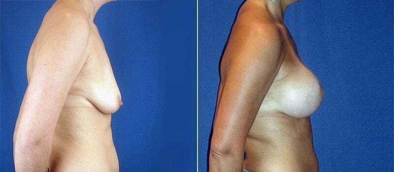 Before and after breast enhancement comparison image