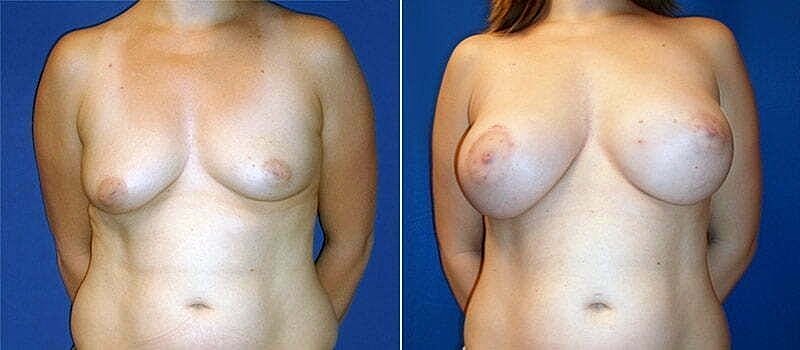 Before and after breast augmentation comparison image