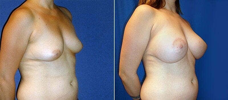 Before and after breast enhancement comparison.