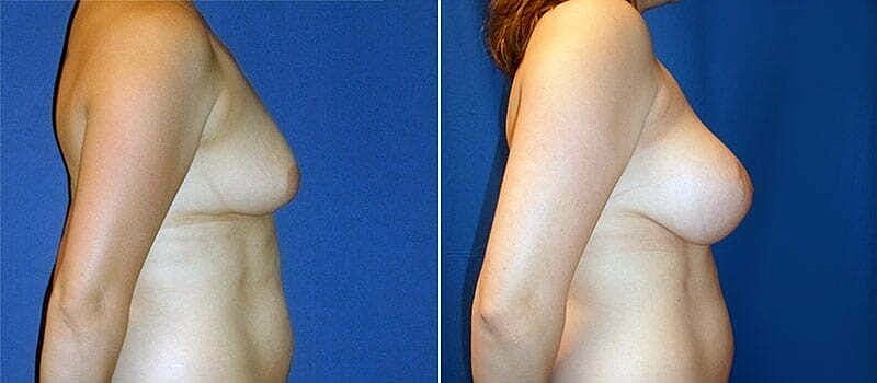 Before and after cosmetic breast procedure comparison.
