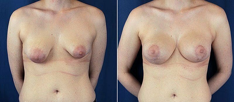 Before and after breast augmentation pictures.