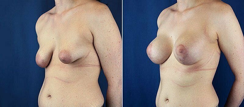 Comparison of two breast shapes side by side