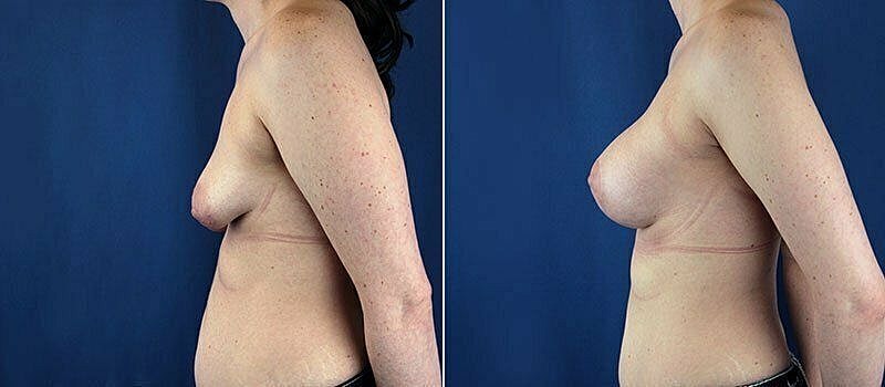 Before and after breast surgery comparison image
