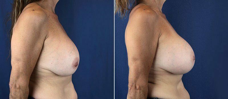 Secondary Revision Before & After