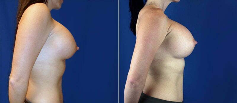 Secondary Revision Before & After