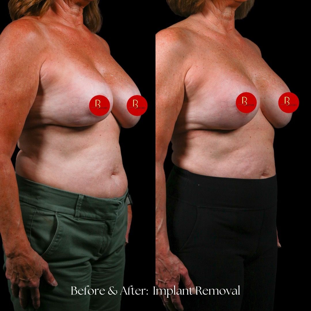 Implant Removal Before & After