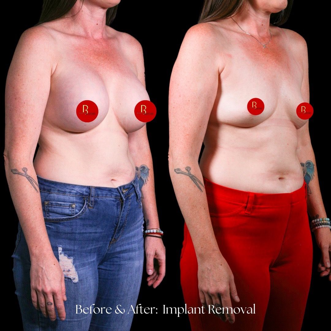 Implant Removal Before & After