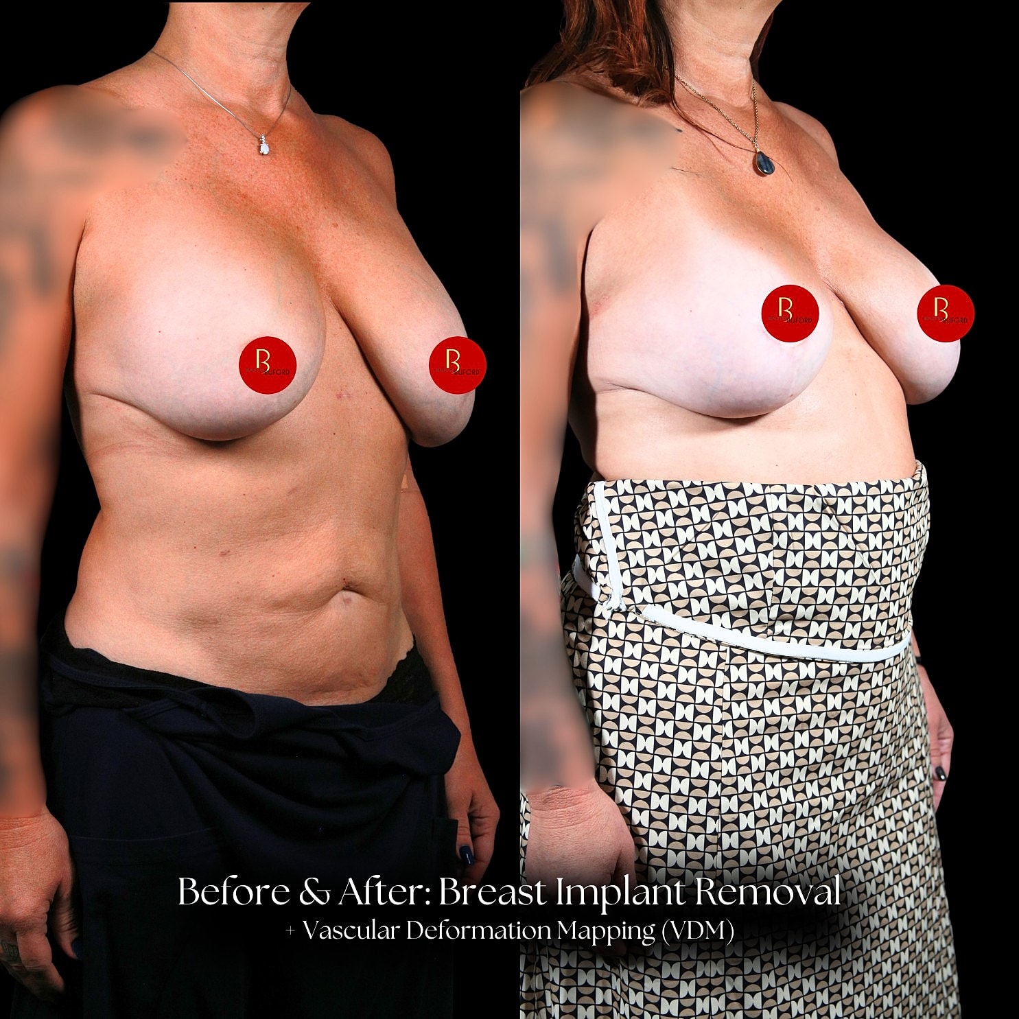 Implant Removal Before & After