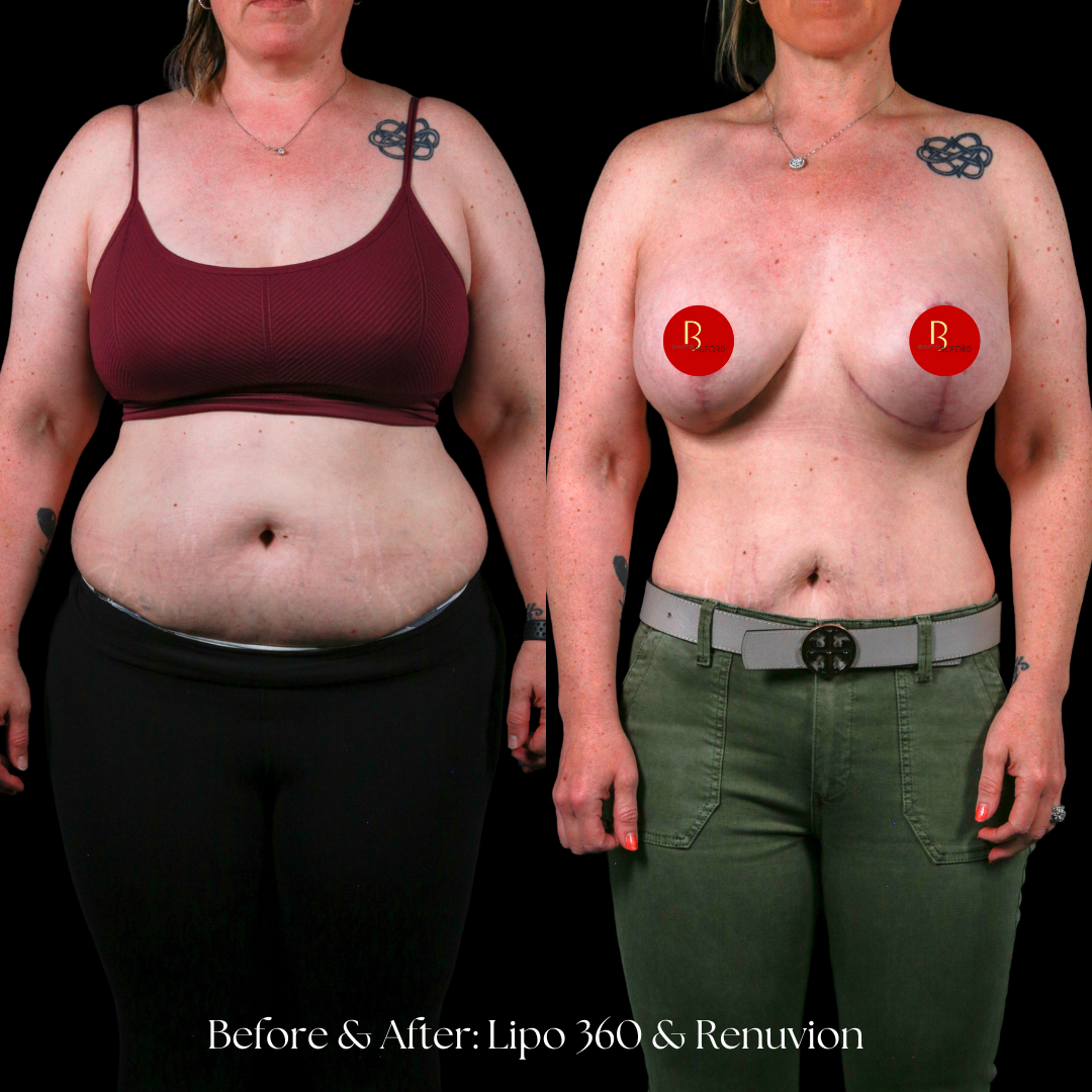 Liposuction  Before & After