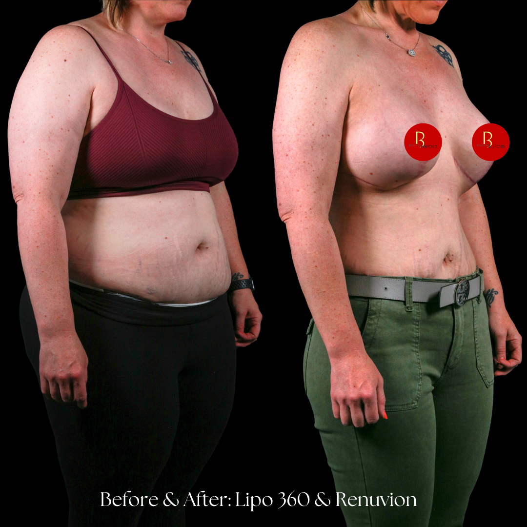 Liposuction  Before & After
