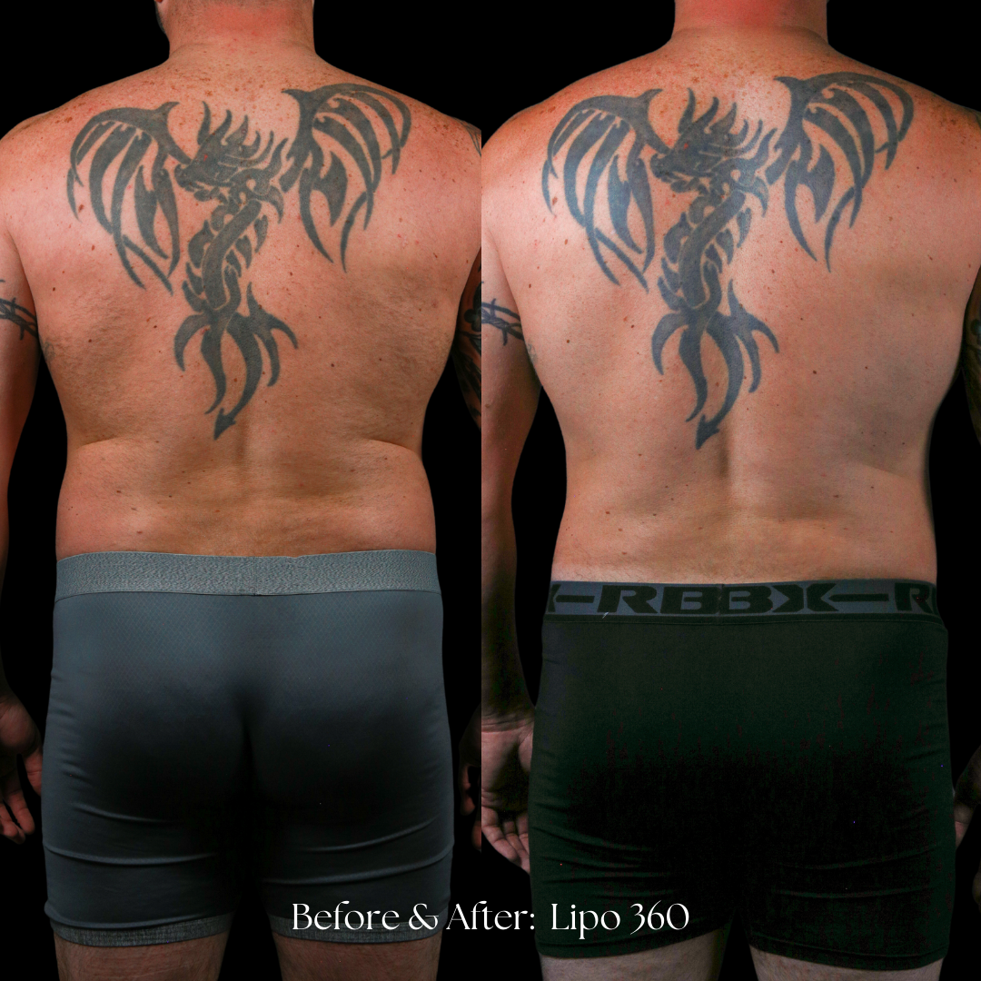 Liposuction  Before & After