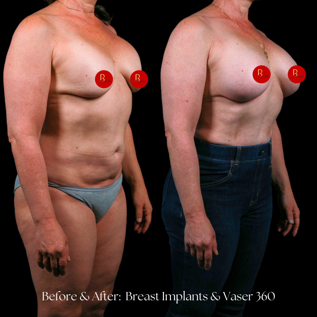 Liposuction  Before & After
