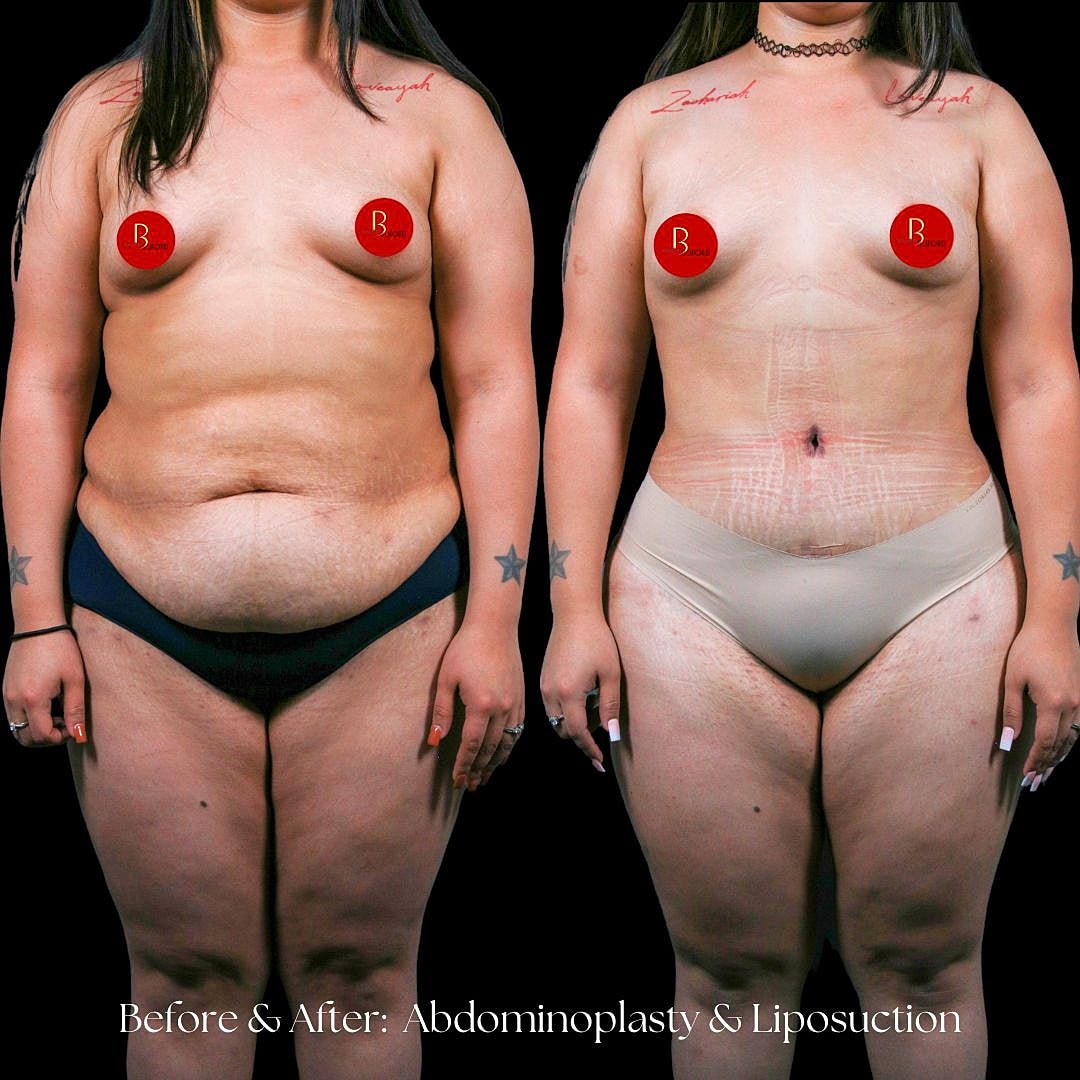 Before and after abdominoplasty and liposuction transformation.