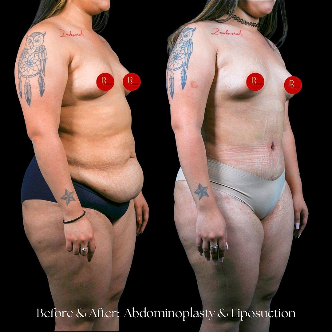 Before and after body transformation surgery demonstration