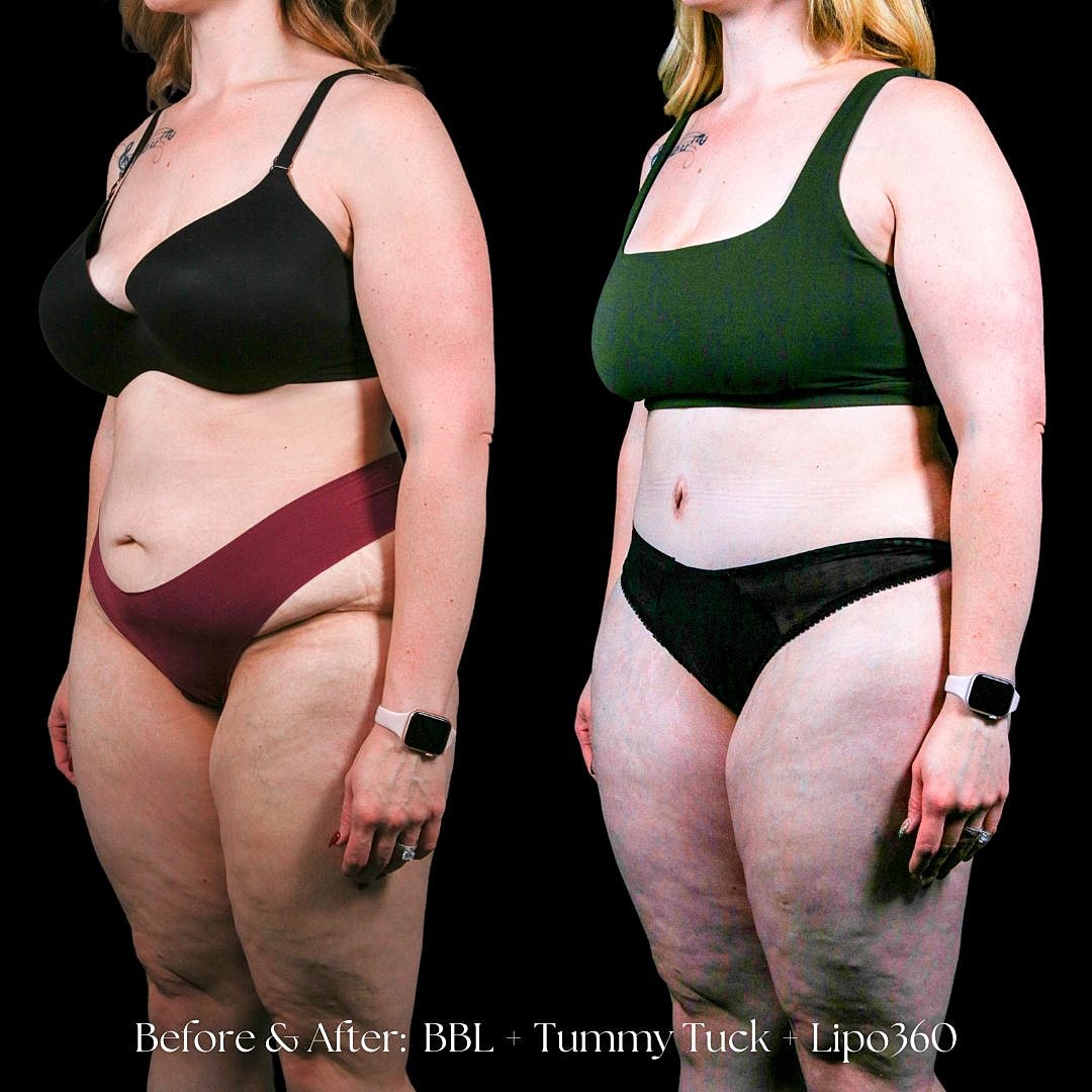 Before and after body transformation surgery comparison.