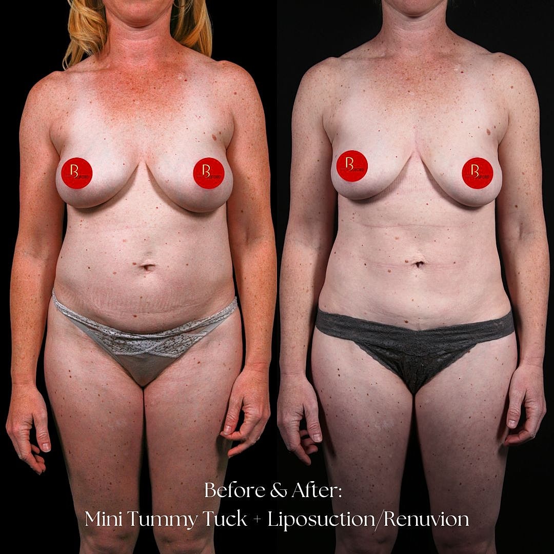 Before and after body transformation surgery comparison