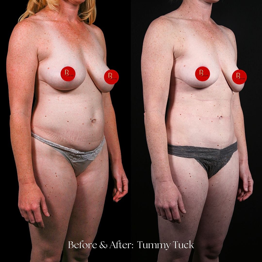 Before and after tummy tuck surgery results