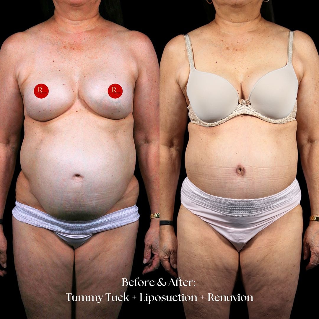 Before and after of body contouring surgery.