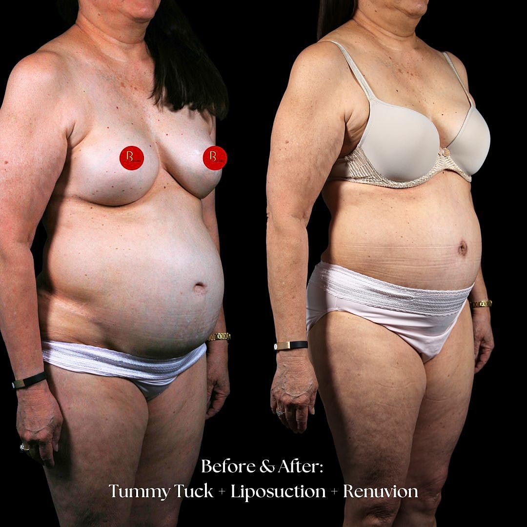 Before and after cosmetic surgery transformation.
