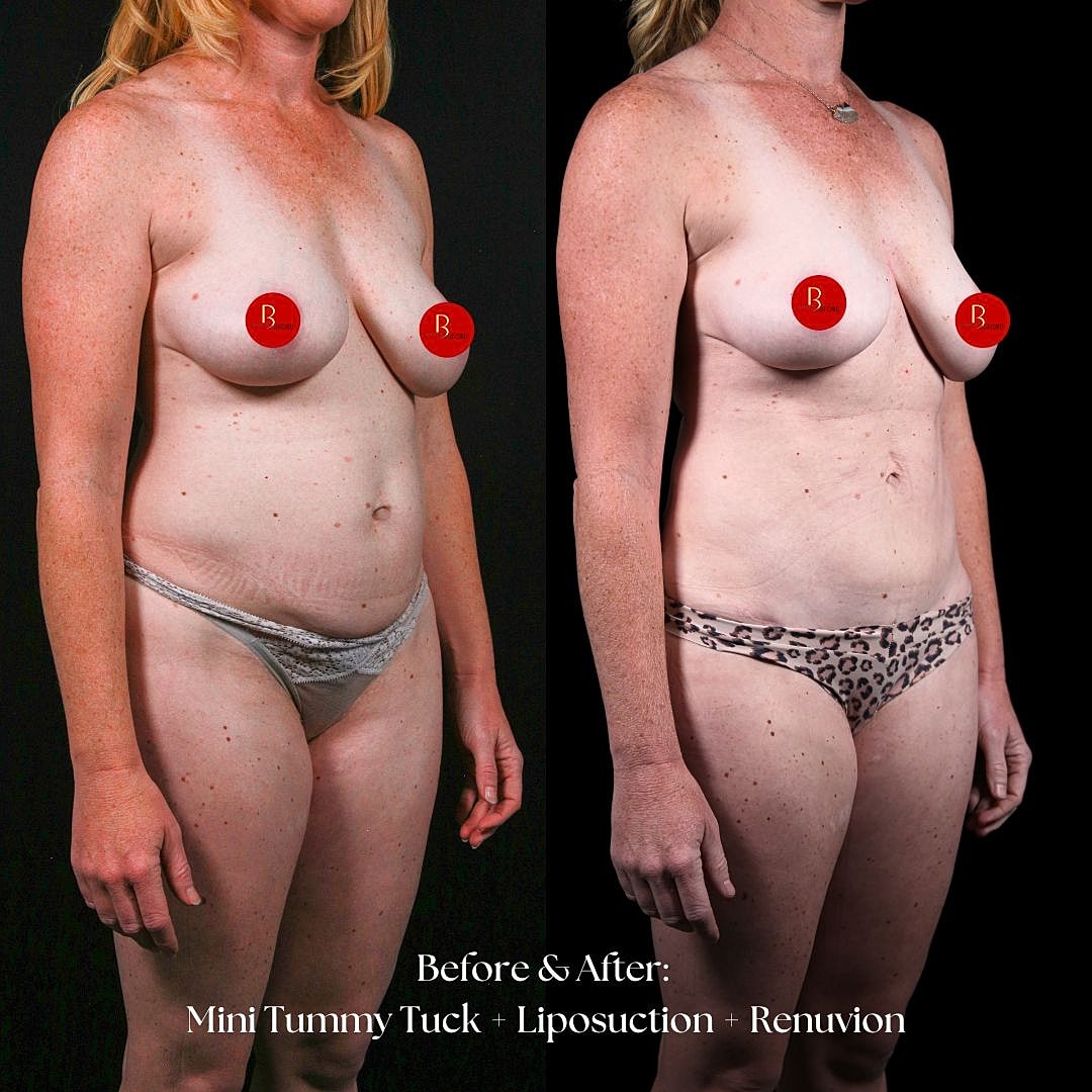 Before and after body contouring transformation images.