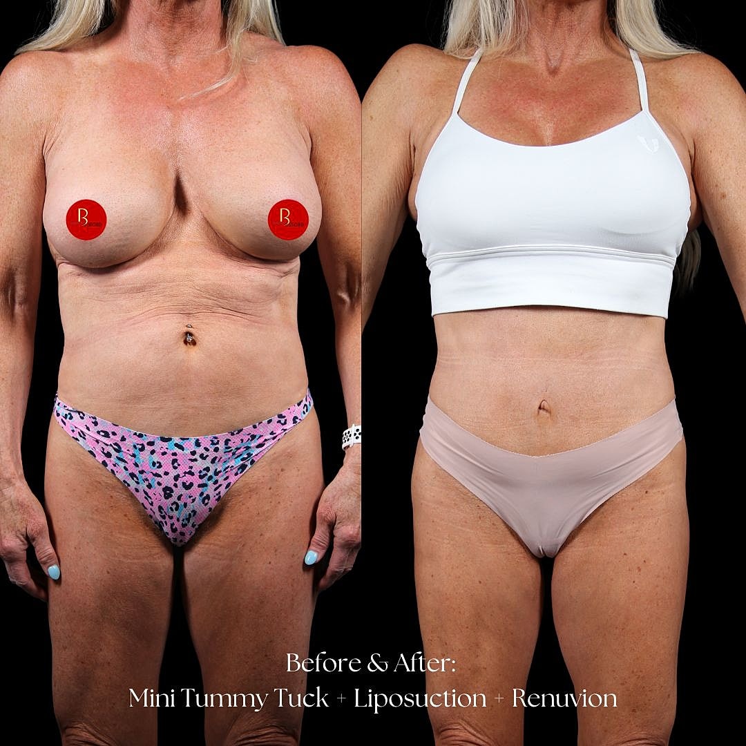 Before and after cosmetic surgery transformation.