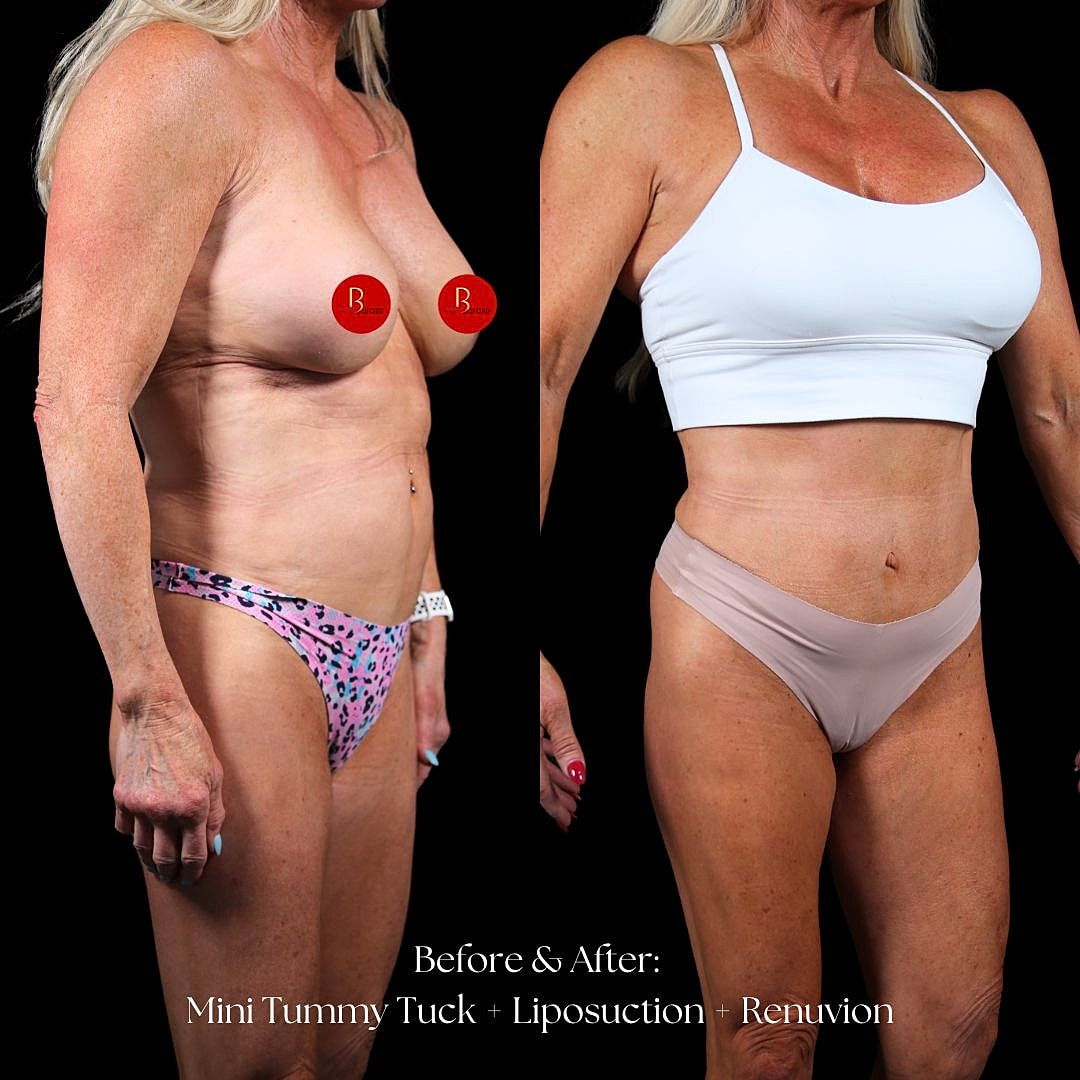 Mini tummy tuck and liposuction before and after.