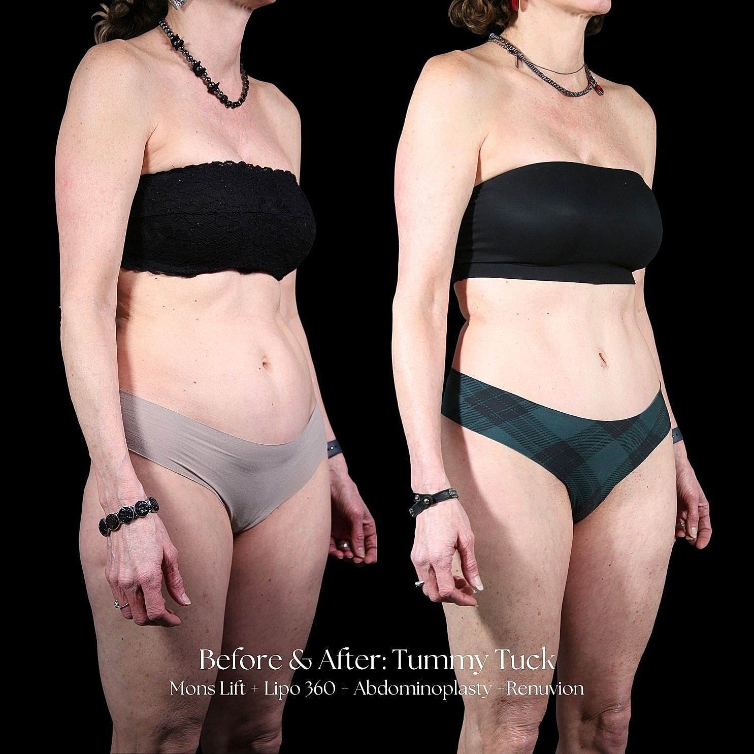 Before and after tummy tuck transformation comparison