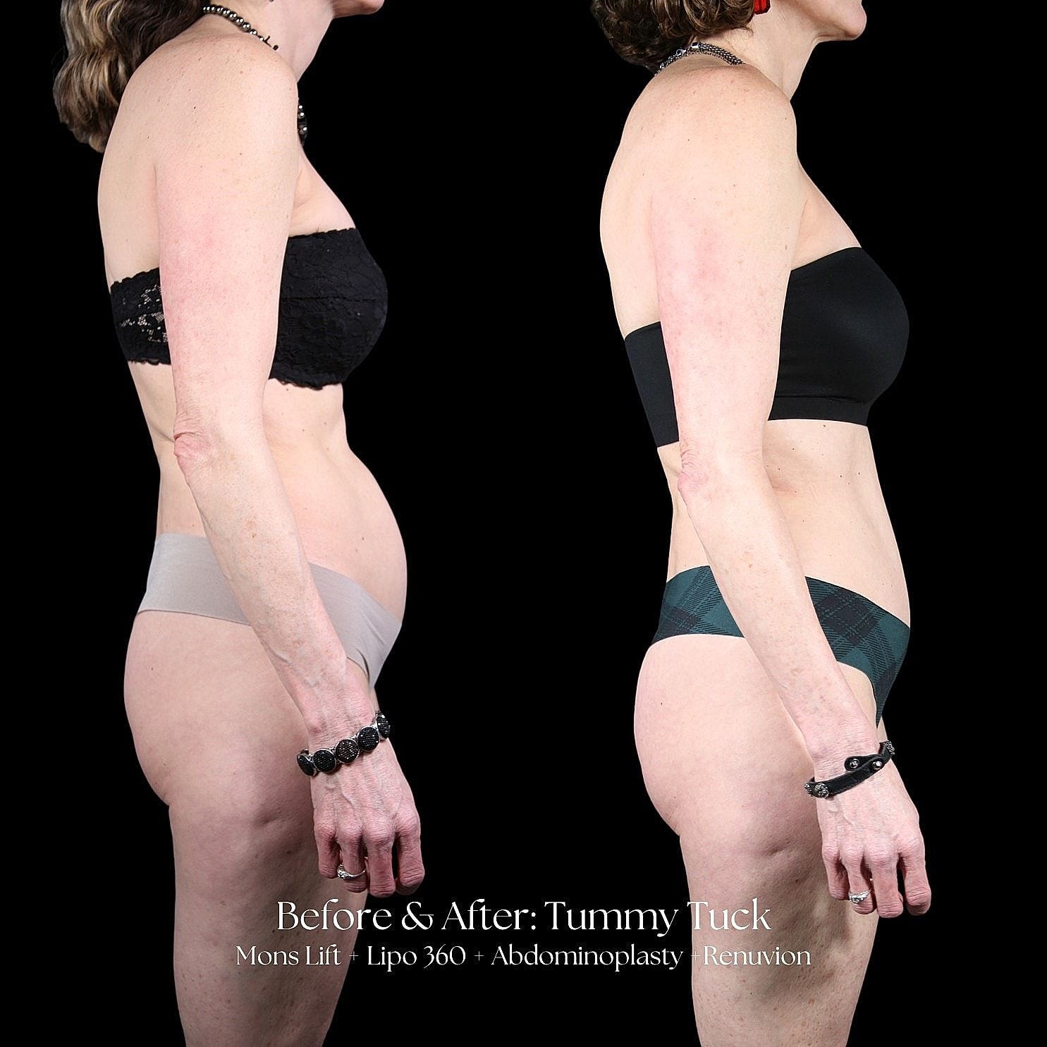 Tummy tuck before and after transformation.